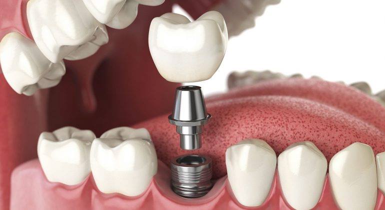 implantati