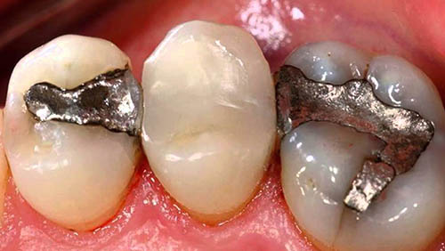 amalgam