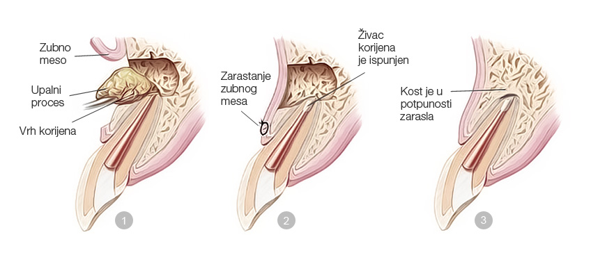 apikotomija
