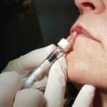 fileri-botox
