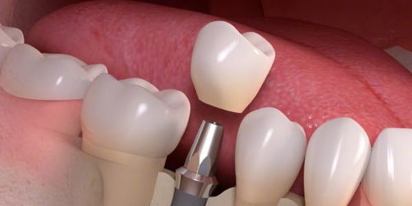 implantat ugradnja-implantata