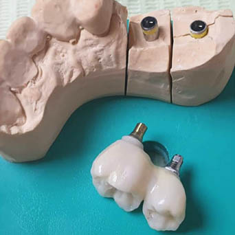 implantologija