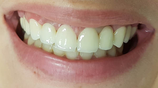 gingivotomija