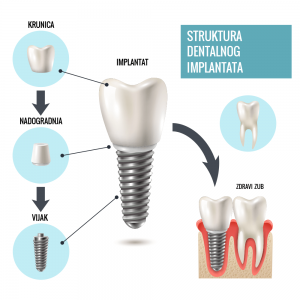 struktura zubnih implantata